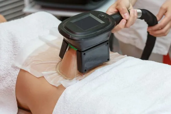 Image of person having fat freezing treatment to help weight gain Cumbernauld