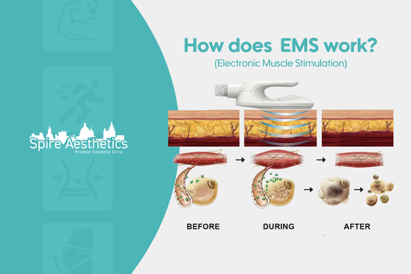 EMS treatment for post pregnancy weight loss treatment Cumbernauld