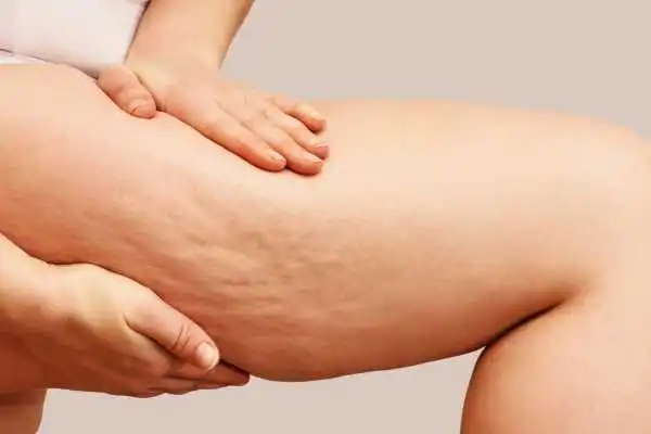 Image of woman showing leg with cellulite Cumbernauld