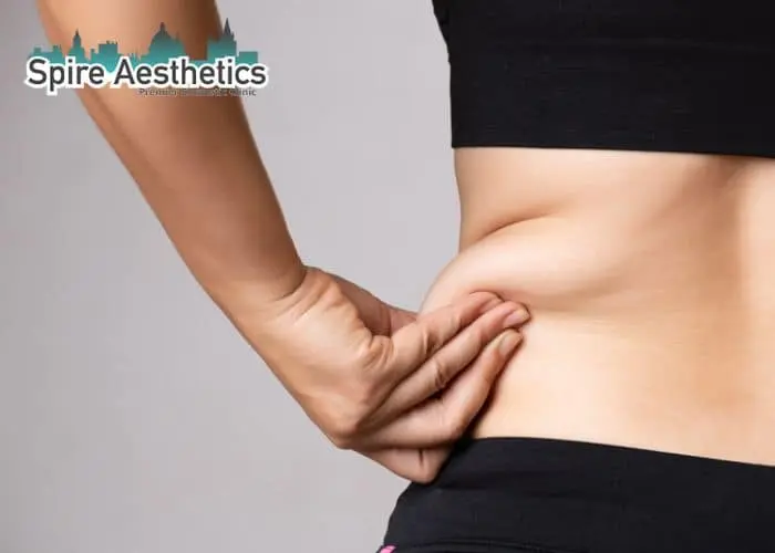Image of woman pinching fat on their hips Cumbernauld. Fat Freezing treatment