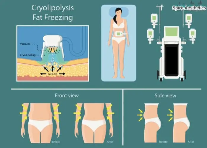 Fat freezing treatment Cumbernauld benefits for competitions to remove stubborn fat deposits.