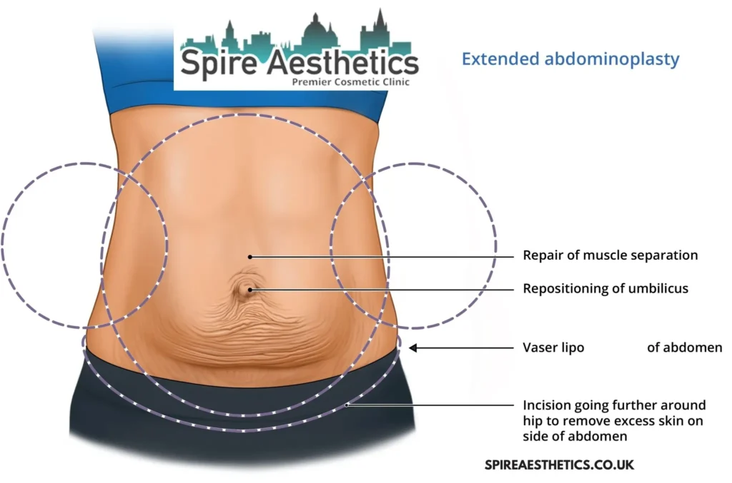 Understanding Loose Skin After Gastric Band Cumbernauld Surgery and HIFU Treatment