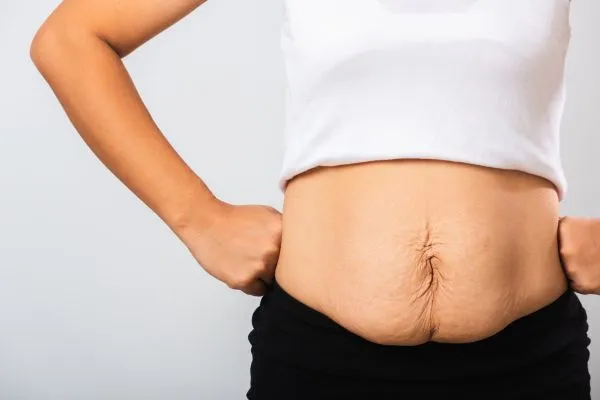 Image of a woman's stomach after weight loss with sagging skin following a gastric band Cumbernauld