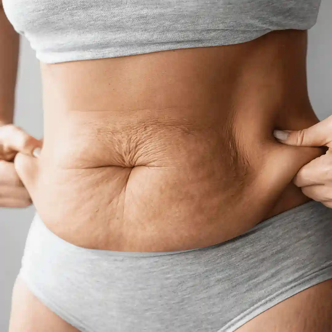 Is It Normal to Have Loose Skin After Pregnancy Cumbernauld?