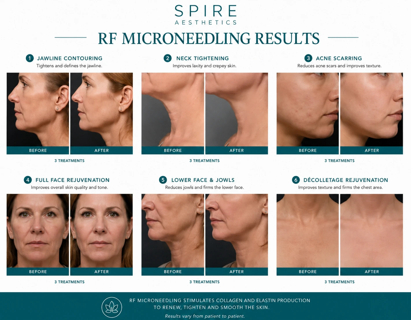 RF Microneedling Skin tightening Cumbernauld results