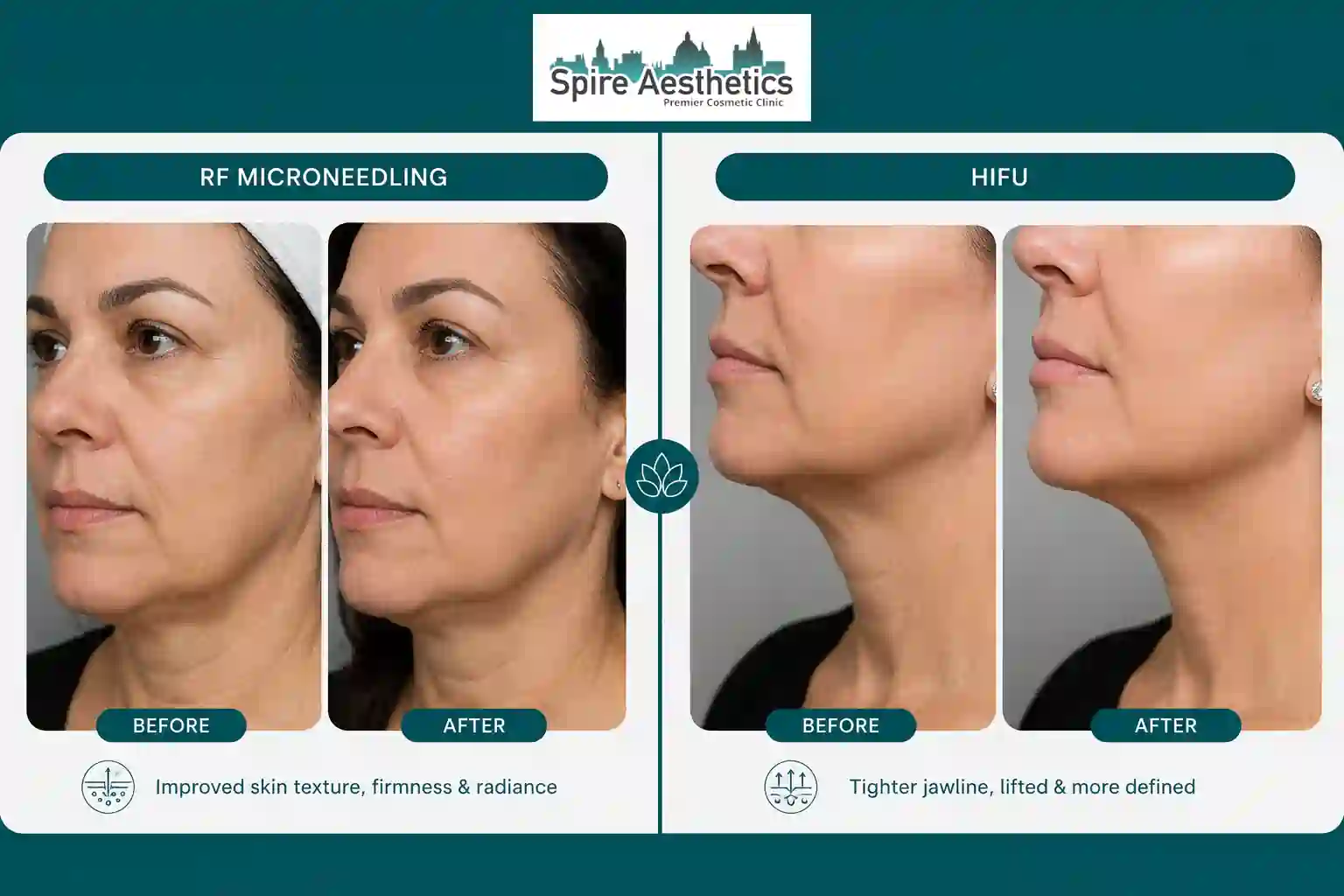 Can RF Microneedling and HIFU Be Combined Cumbernauld?