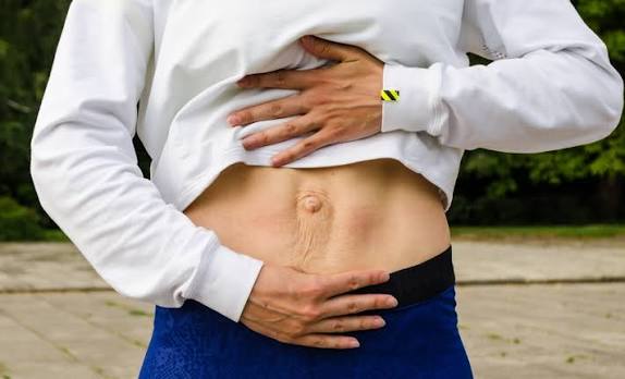 When Could Diastasis Recti Be the Missing Piece of the Puzzle Cumbernauld?