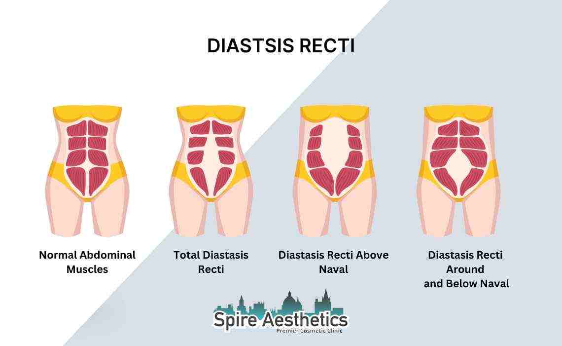 Is Non-Surgical Diastasis Recti Treatment Right for You? Common Concerns Answered Cumbernauld
